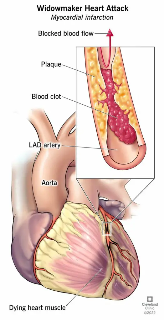 24507 widowmaker heart attack illustration