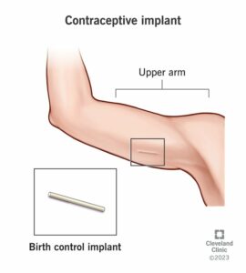 24564 contraceptive implant