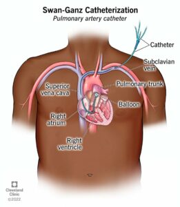 24606 swan ganz catheter