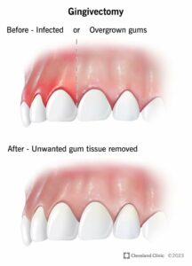 24749 gingivectomy