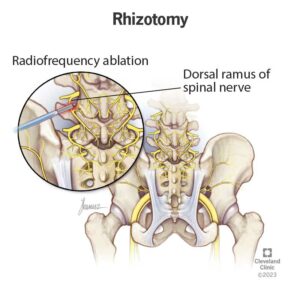 24903 rhizotomy