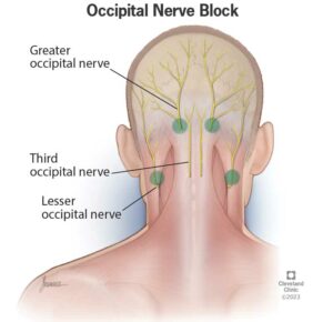 24934 occipital nerve block