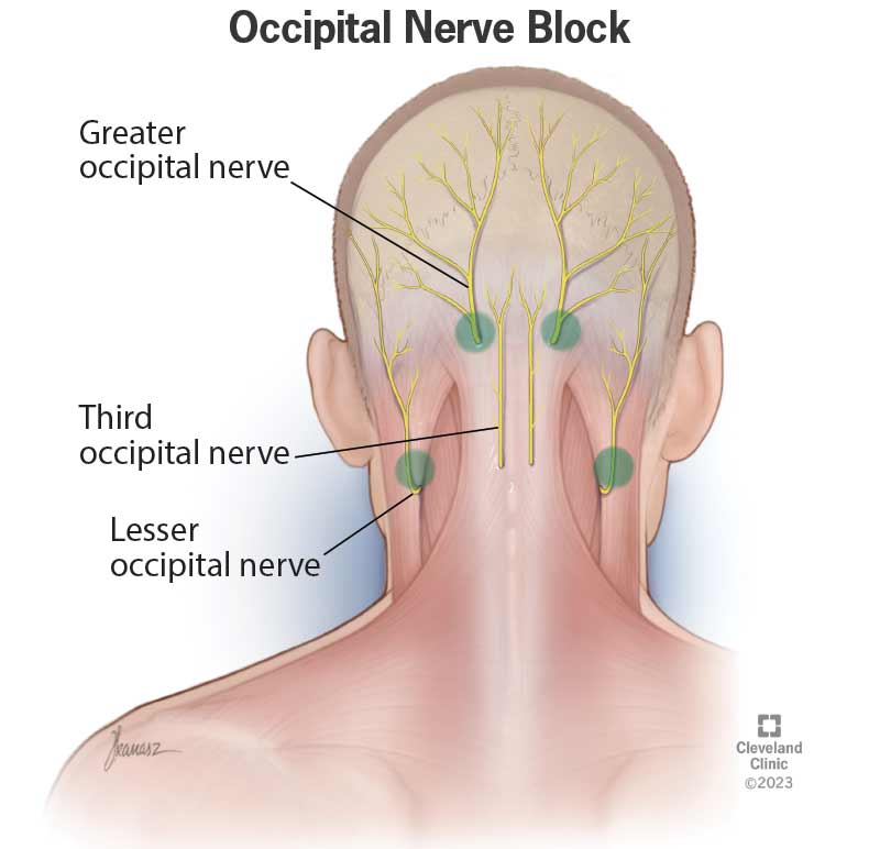 24934 occipital nerve block