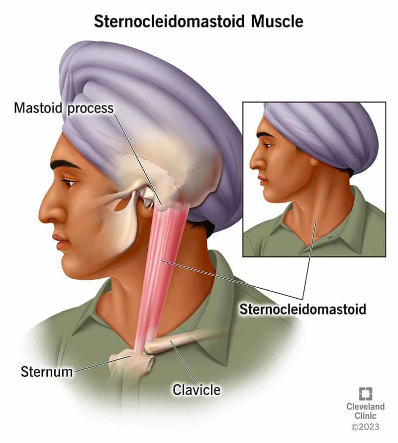 mis-on-sternocleidomastoid-scm-lihas-sfomc