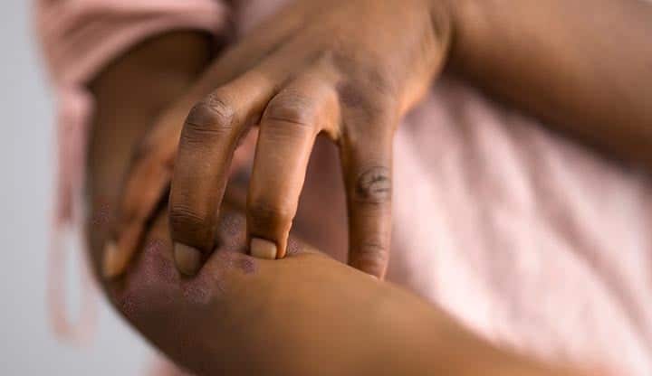 24941 how psoriasis affects black people