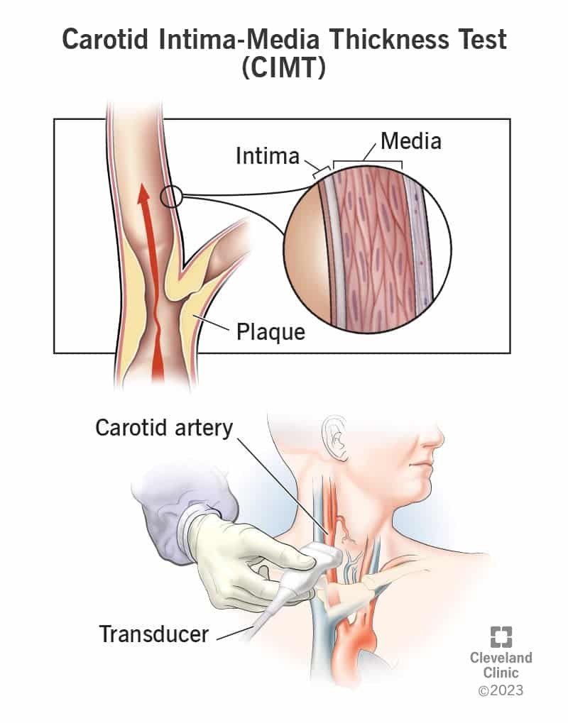 24944 carotid intima media thickness test