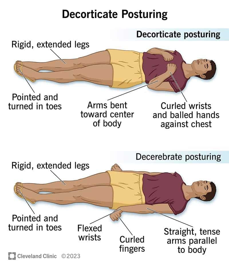 24969 decorticate posturing