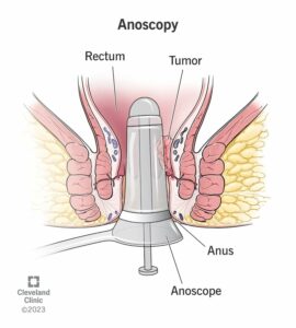 24993 anoscopy