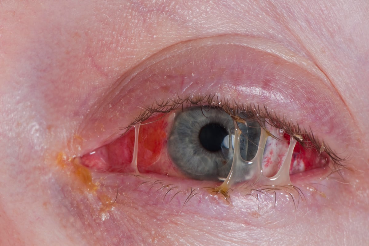 Silmapõletikud põhjustavad sageli silmade punetust ja sügelemist ning kleepuva mäda eritumist, mis põhjustab silmalaugude kokkukleepumist.
