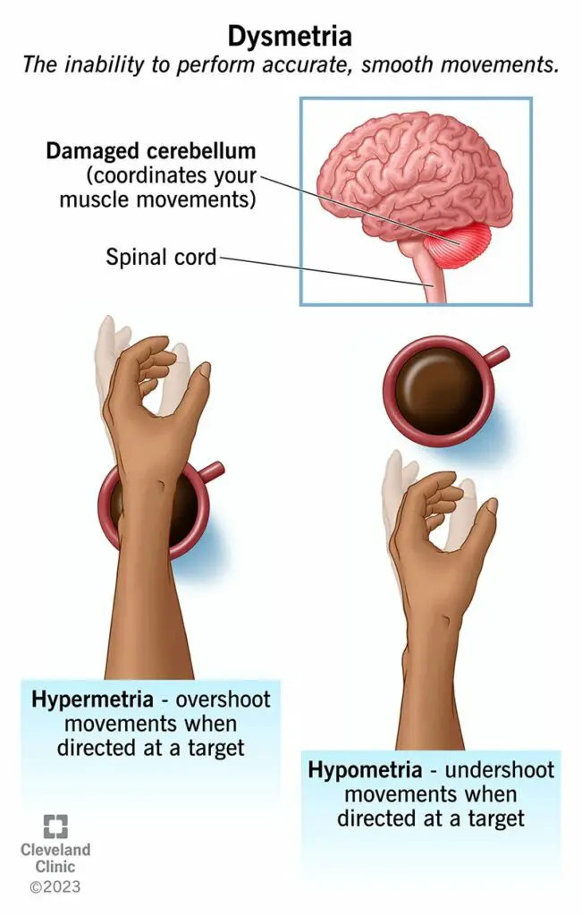 25232 dysmetria