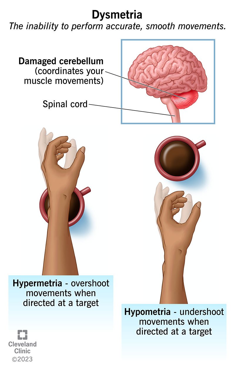 Düsmeetria: käe üle- (hüpermeetria) ja alakõrvetus (hüpomeetria), mis ulatub kohvitassi järele.