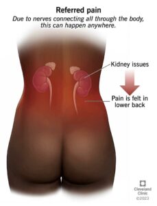 25238 referred pain