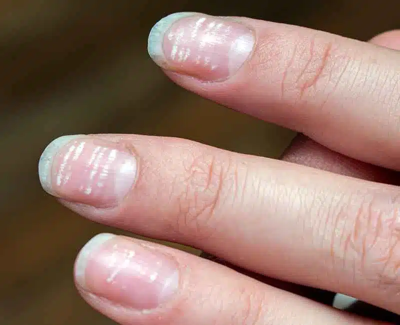 25243 white spots on nails