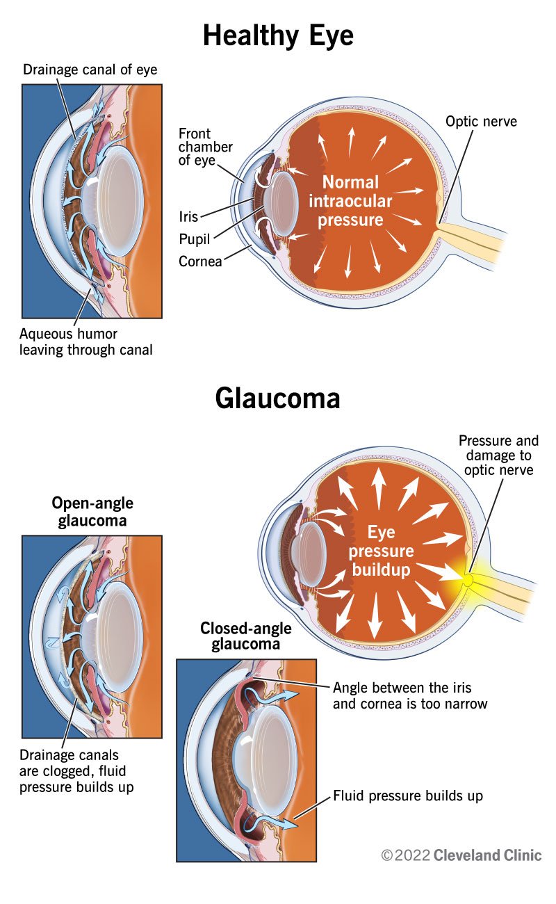 Tervete nägemisnärvidega silmades voolab vesivedelik läbi drenaažikanalite, samas kui glaukoomiga silmades kahjustatakse nägemisnärve vedeliku ja rõhu kogunemisel.