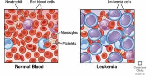 4365 leukemia