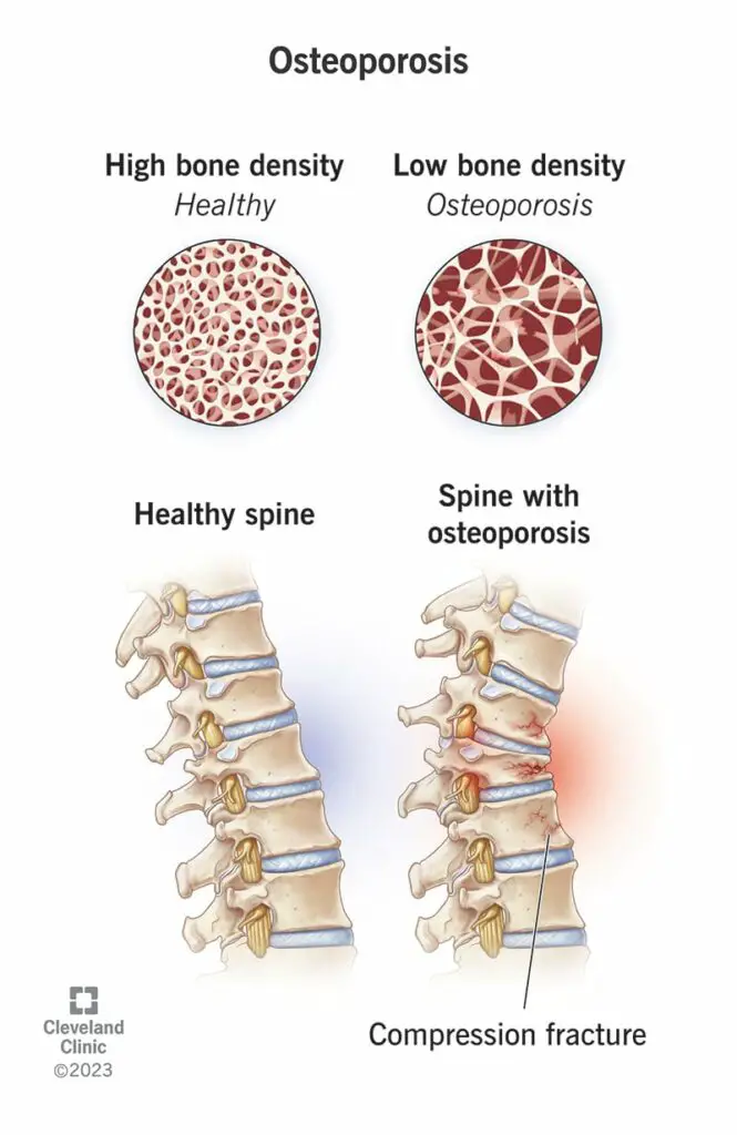 4443 osteoporosis