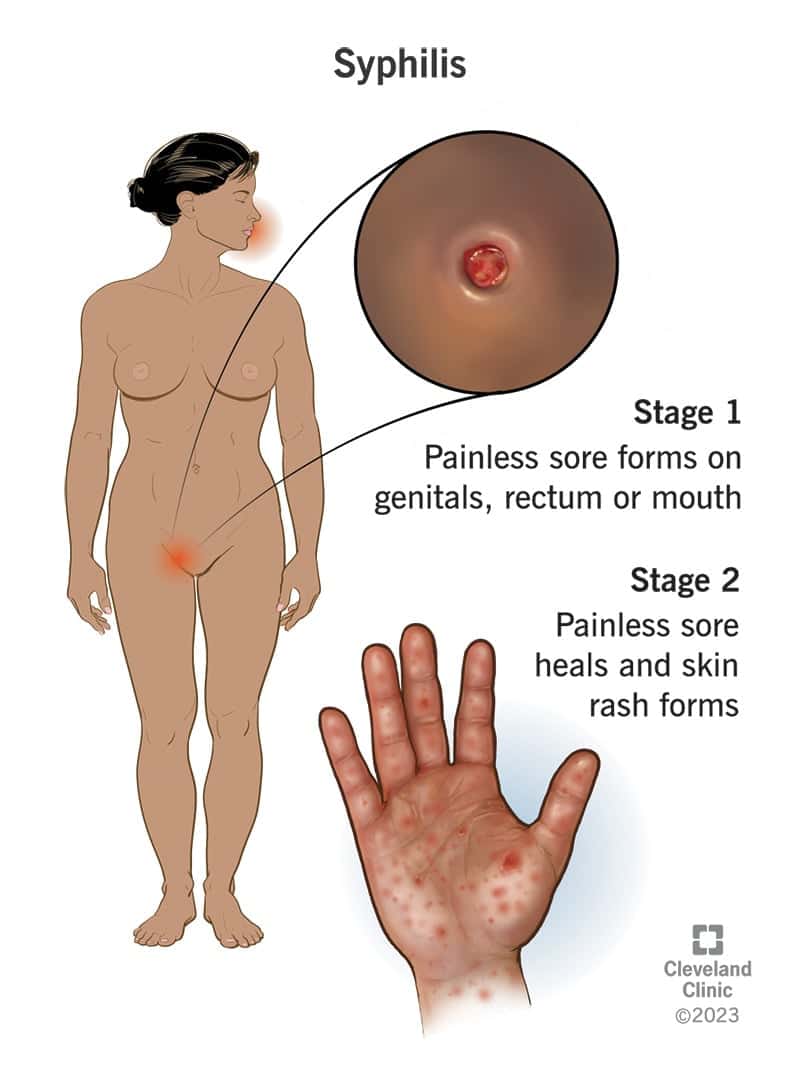Naise keha, mis näitab, kus teie kehal tekivad süüfilise haavandid ja kus nahalööve pärast seda.