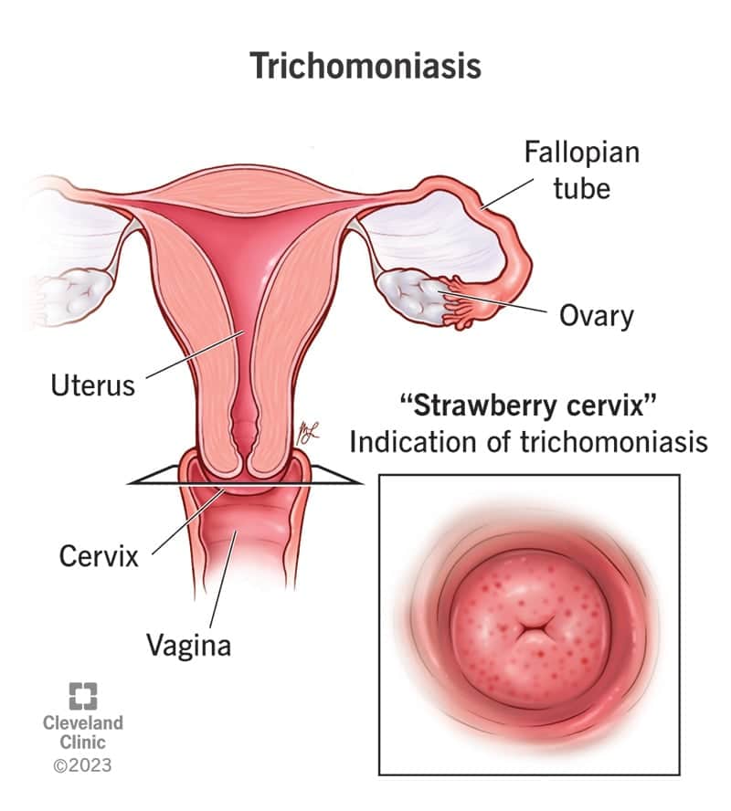 4696 trichomoniasis