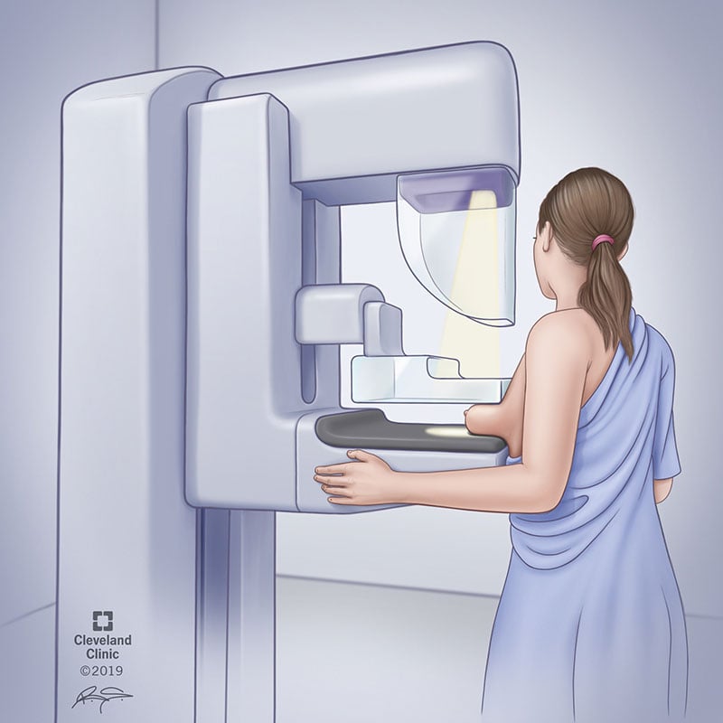 4877 mammogram illustration