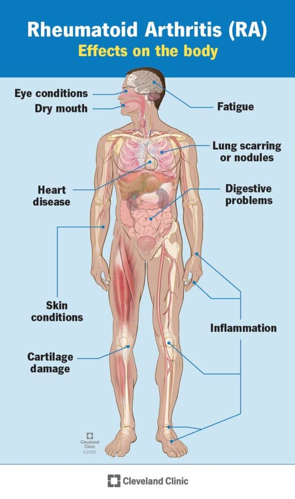 4924 rheumatoid arthritis 2