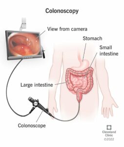 4949 colonoscopy