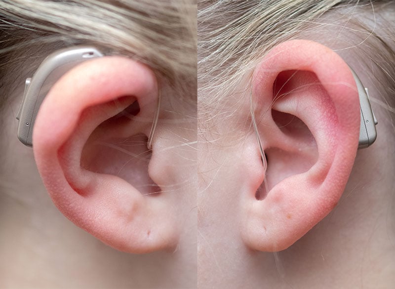 Noore tüdruku kõrv kannab CROS/BiCROS tüüpi kõrvaklappe.