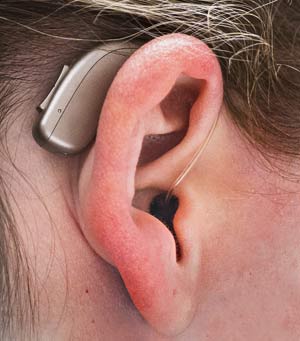 Ear wearing Receiver-in-the-ear (RITE) tüüpi kuuldeaparaat.