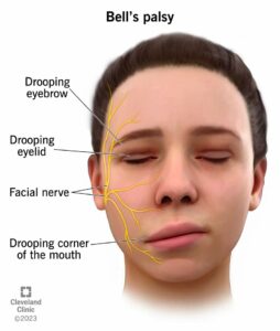 5457 bells palsy