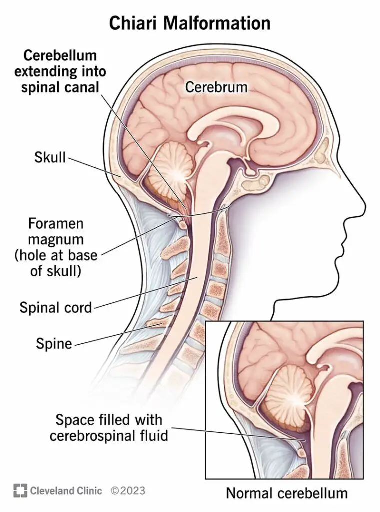 6008 chiari malformation