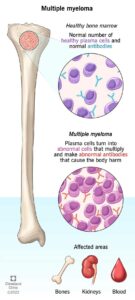 6178 multiple myeloma