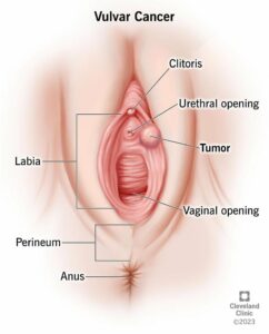 6220 vulvar cancer