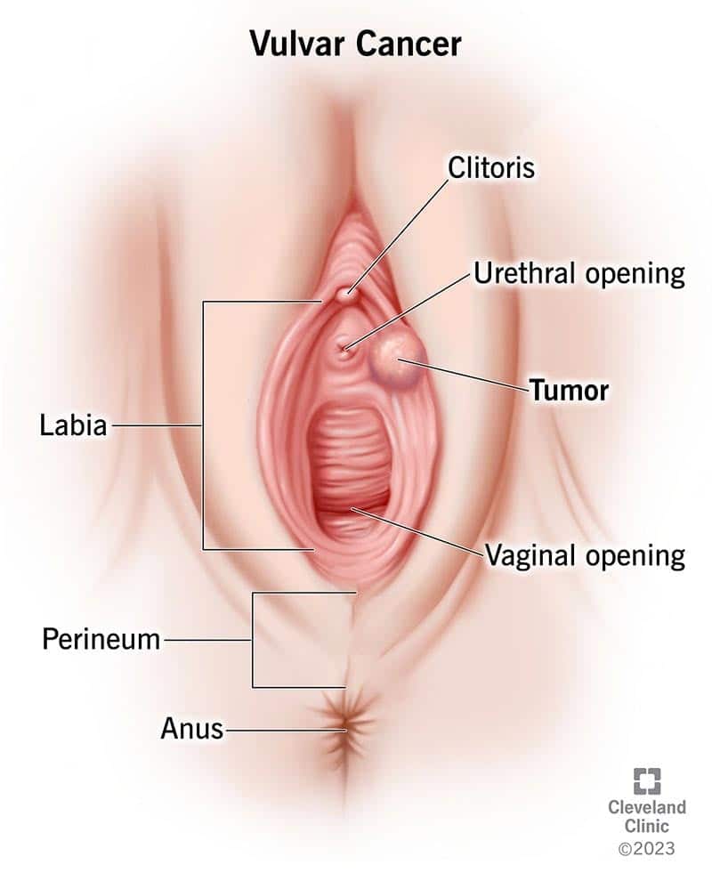6220 vulvar cancer