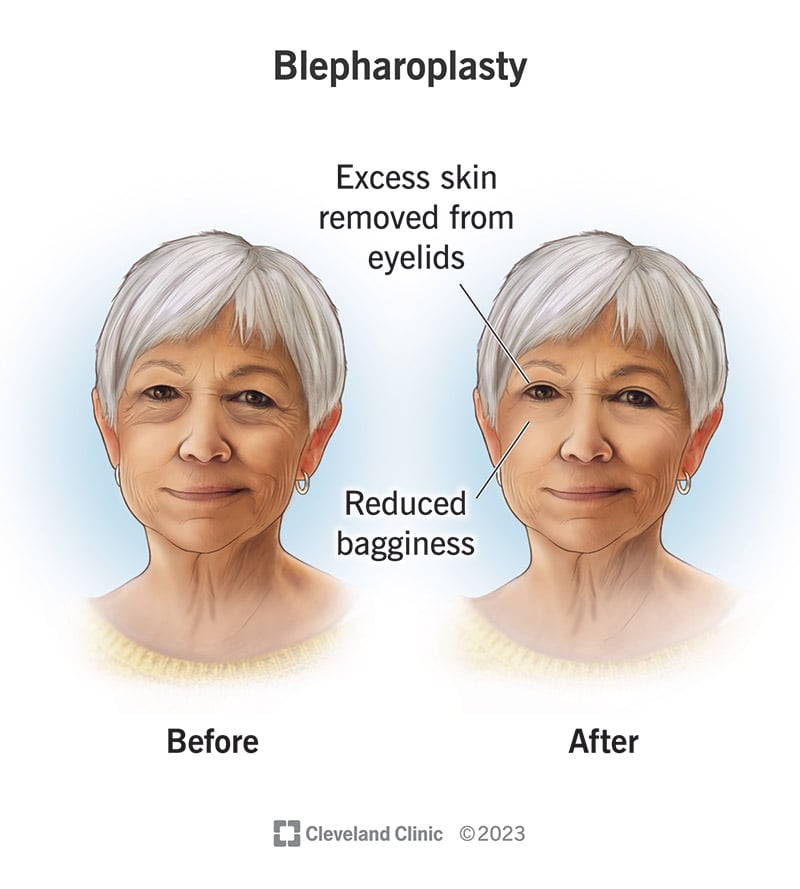 8409 eyelid surgery blepharoplasty