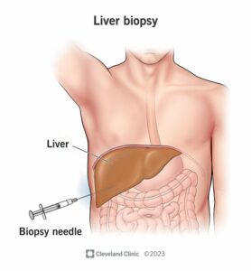 9503 liver biopsy