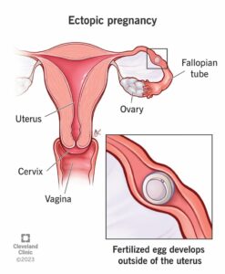 9687 ectopic pregnancy