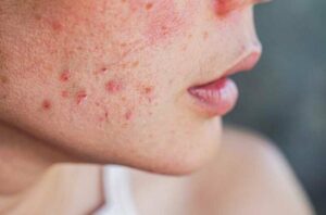 Hormonal Acne Period 1270415883 770x533 1 650x428