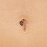 Navel Melanoma