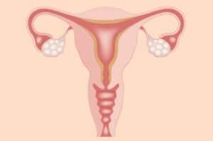 OvarianCysts 826638784 770x533 1 650x428