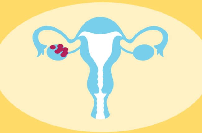 PCOS uterusOvaries 883164360 770x533 1