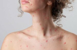 adultChickenPox 163354487 770x553 650x428