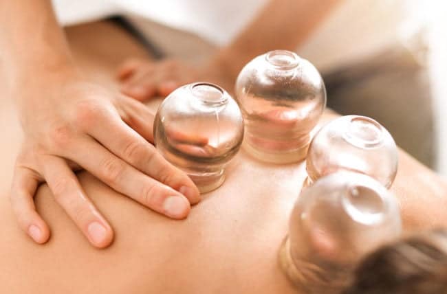 cuppingTherapy 1246919695 770x533 1