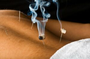 moxibustion 147320515 770x533 650x428