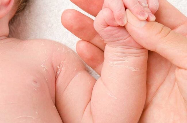 newborn skin peeling 1165471859 770x533 1