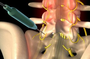 radiofrequencyAblation CMAP SaboM 770x533 1 650x428