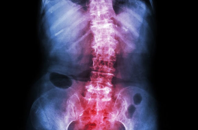 scoliosis 493630376 770x553