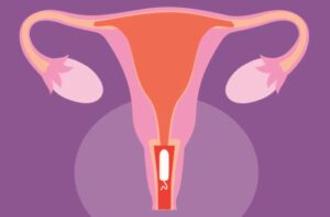 tampon in uterus 1253922218 770x533 1 650x428