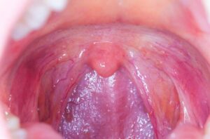 throat 815806282 1 650x428