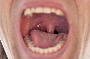 tonsil stone 1 650x428