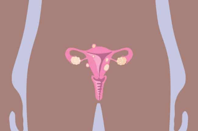 uterine Fibroid Tumors 1428226251 770x533 1