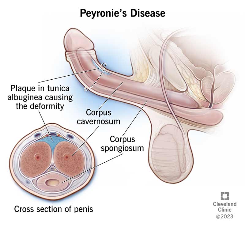 10044 peyronies disease